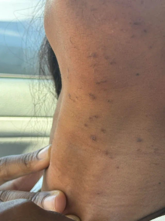Comment traiter un poil incarné sur peau noire et métisse