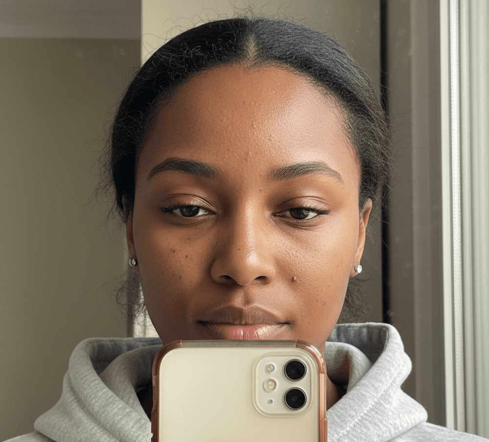 Différencier filaments sébacés et points noirs sur les peaux mates