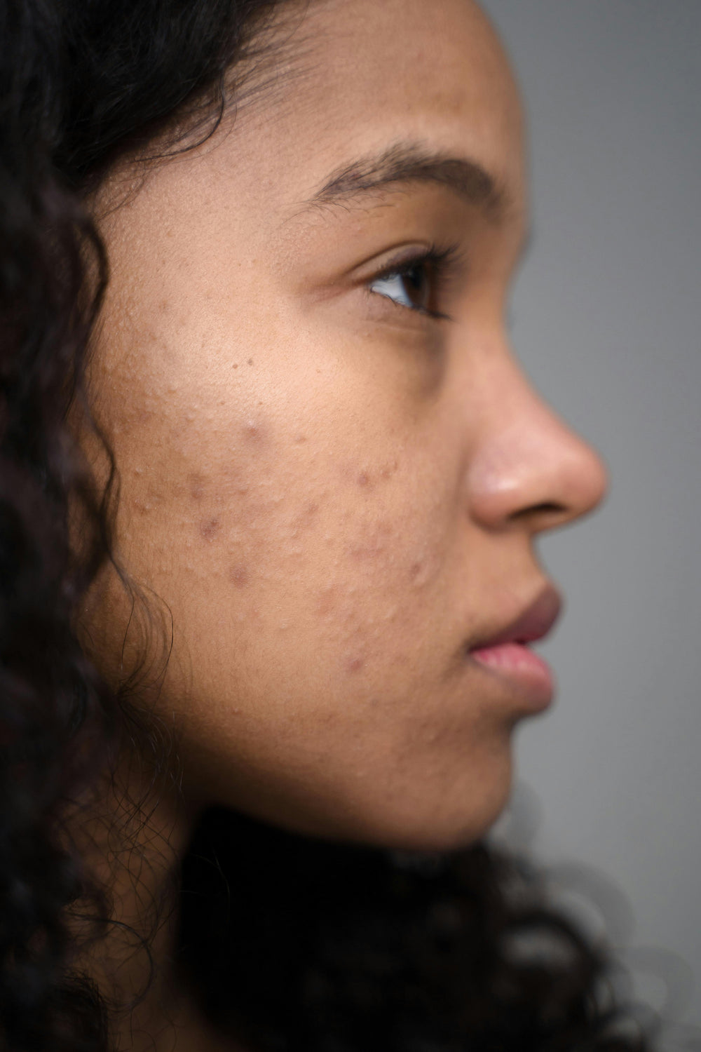 Taches d'acné sur peau noire : comment les estomper sans abîmer sa peau ?