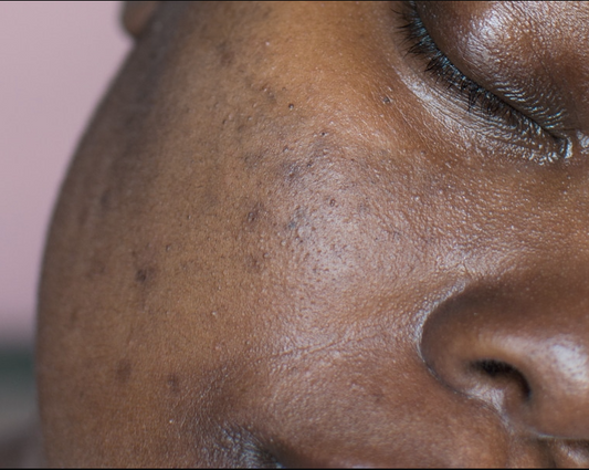 Le mélasma : comprendre, traiter et prévenir l’hyperpigmentation sur peau noire