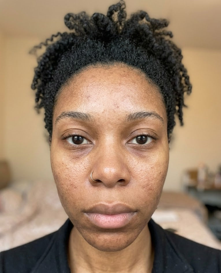 Les cernes sur peau noire : Comment s'en débarrasser ?