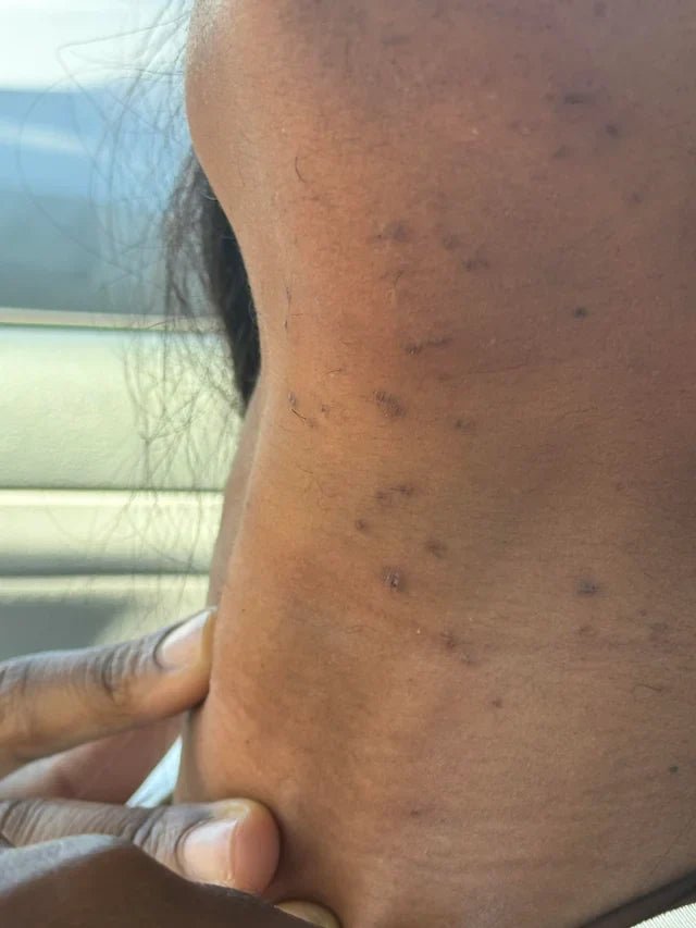 Comment traiter un poil incarné sur peau noire et métisse