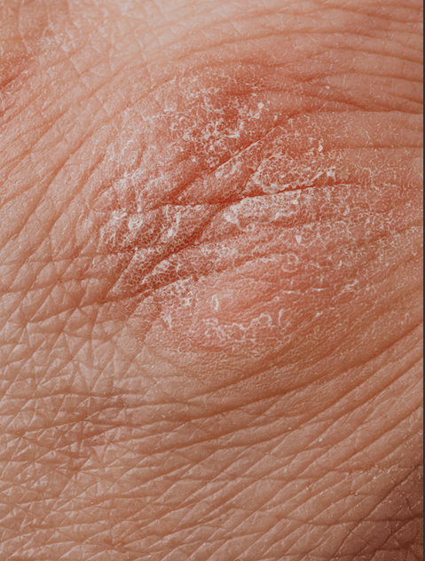 Vivre avec l’eczéma sur peau noire: défis et solutions